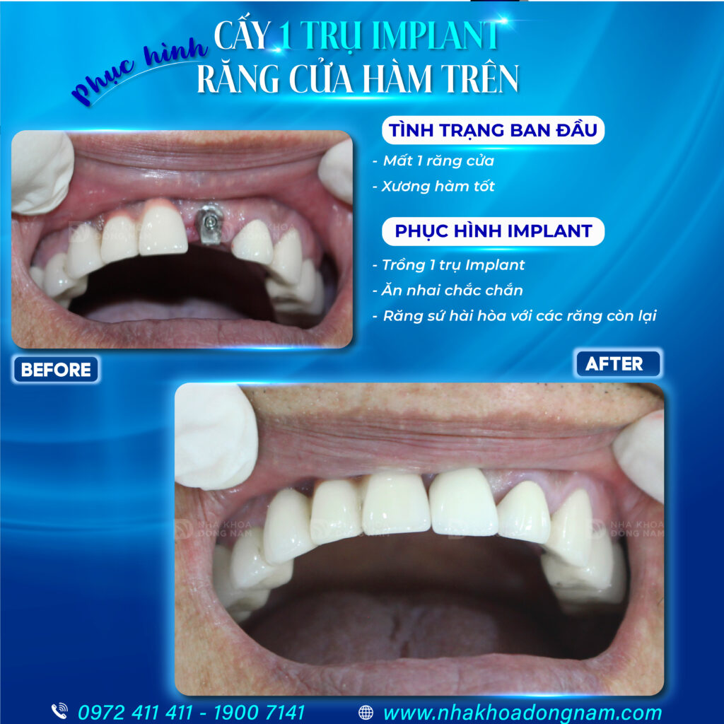 Implant 1 trụ cho 1 răng mất