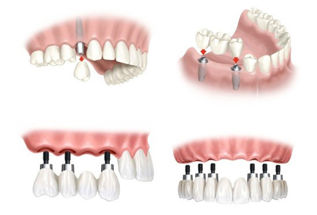 5 lý do tại sao bạn nên quyết định có nên cấy ghép răng Implant hay không