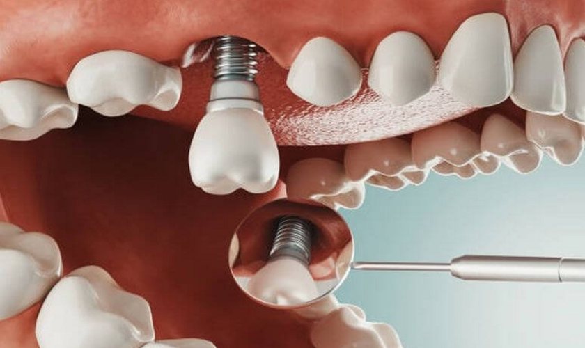 Cấy ghép răng có đau không? Chuyên môn